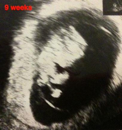 Fetus At 9 Weeks. at 9 weeks gestation